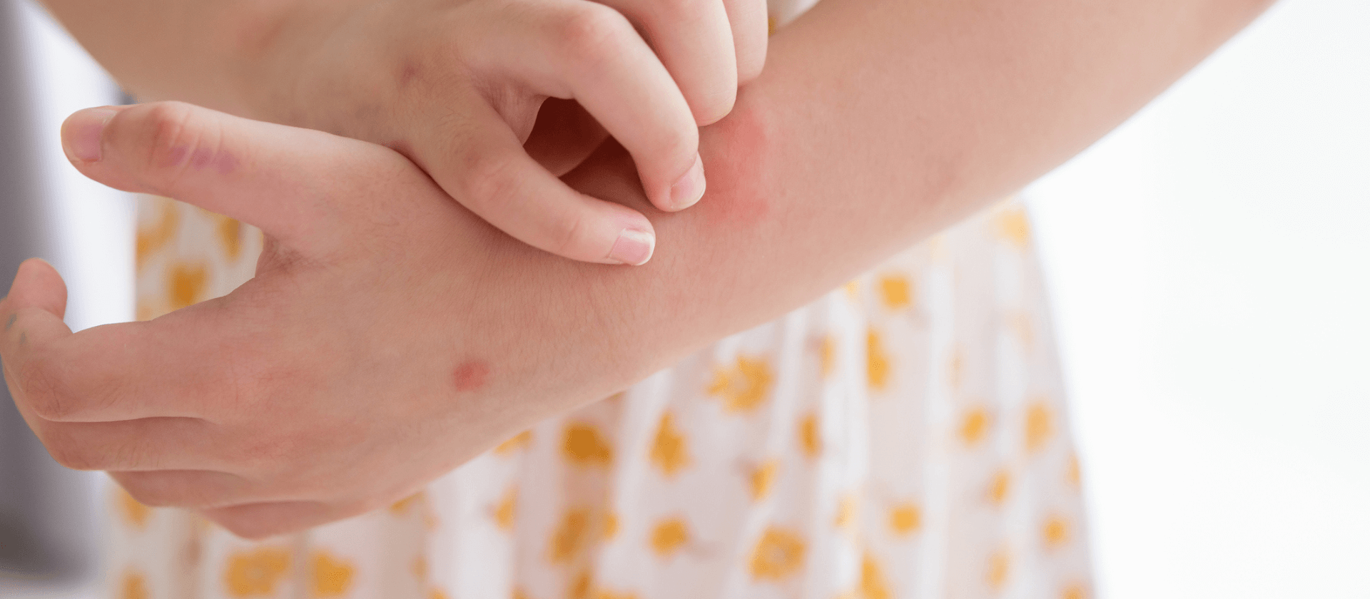 a girl with psoriasis on her hands