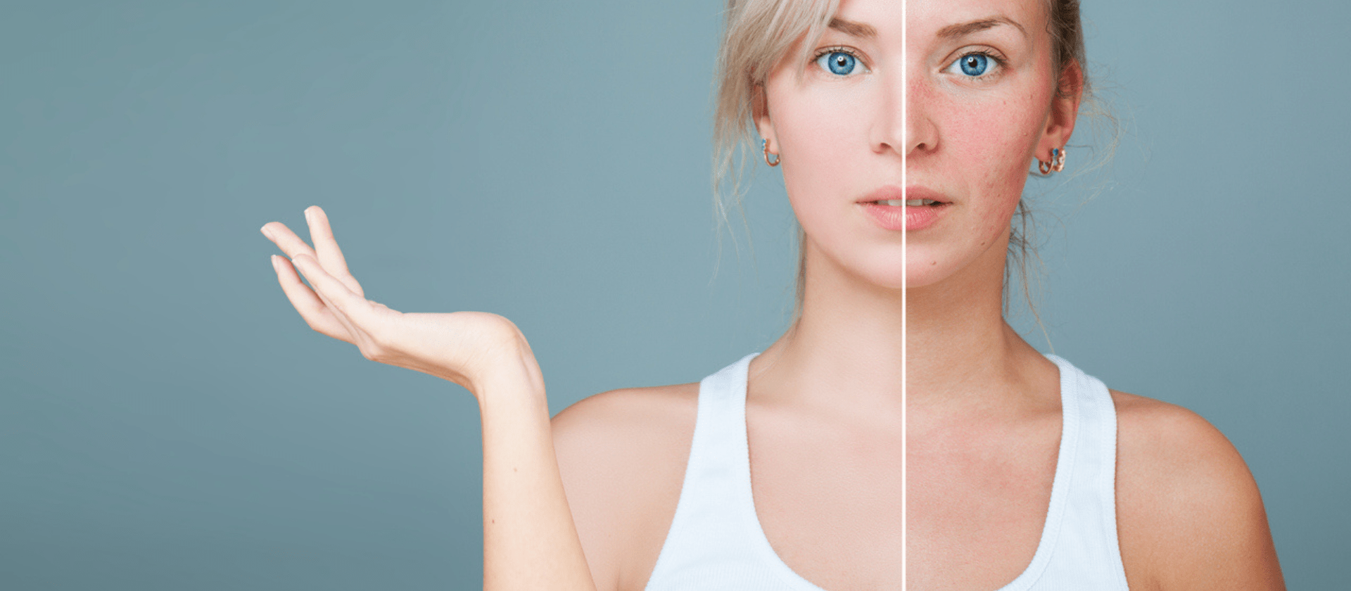 a girl dealing with rosacea