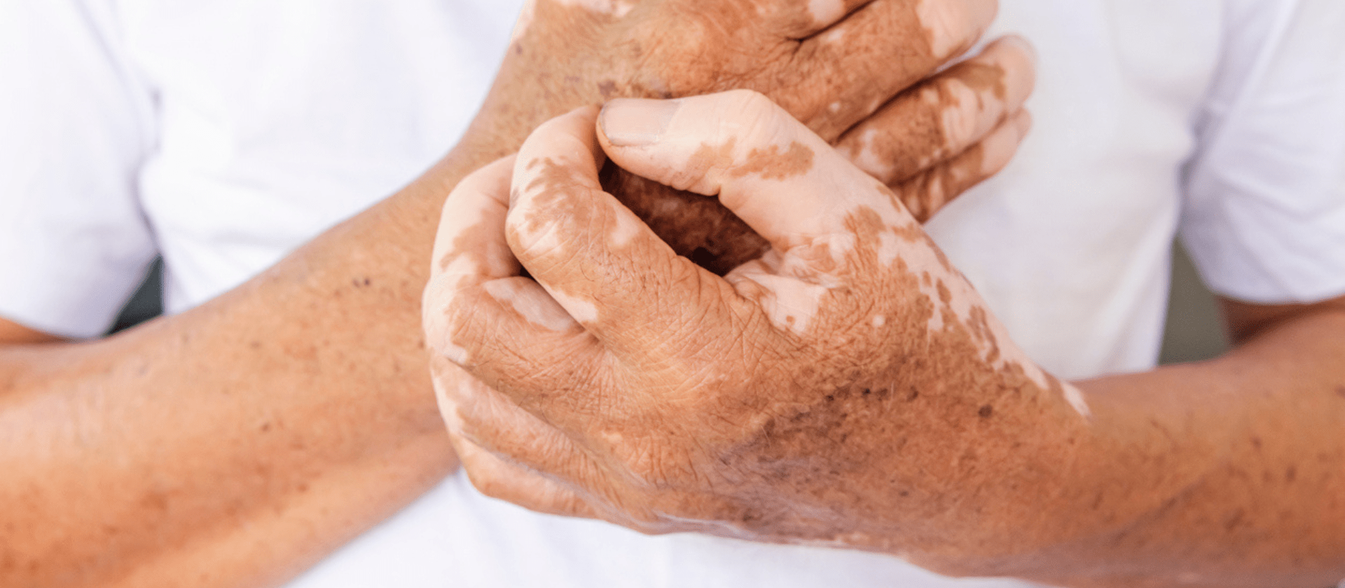vitiligo on the hands