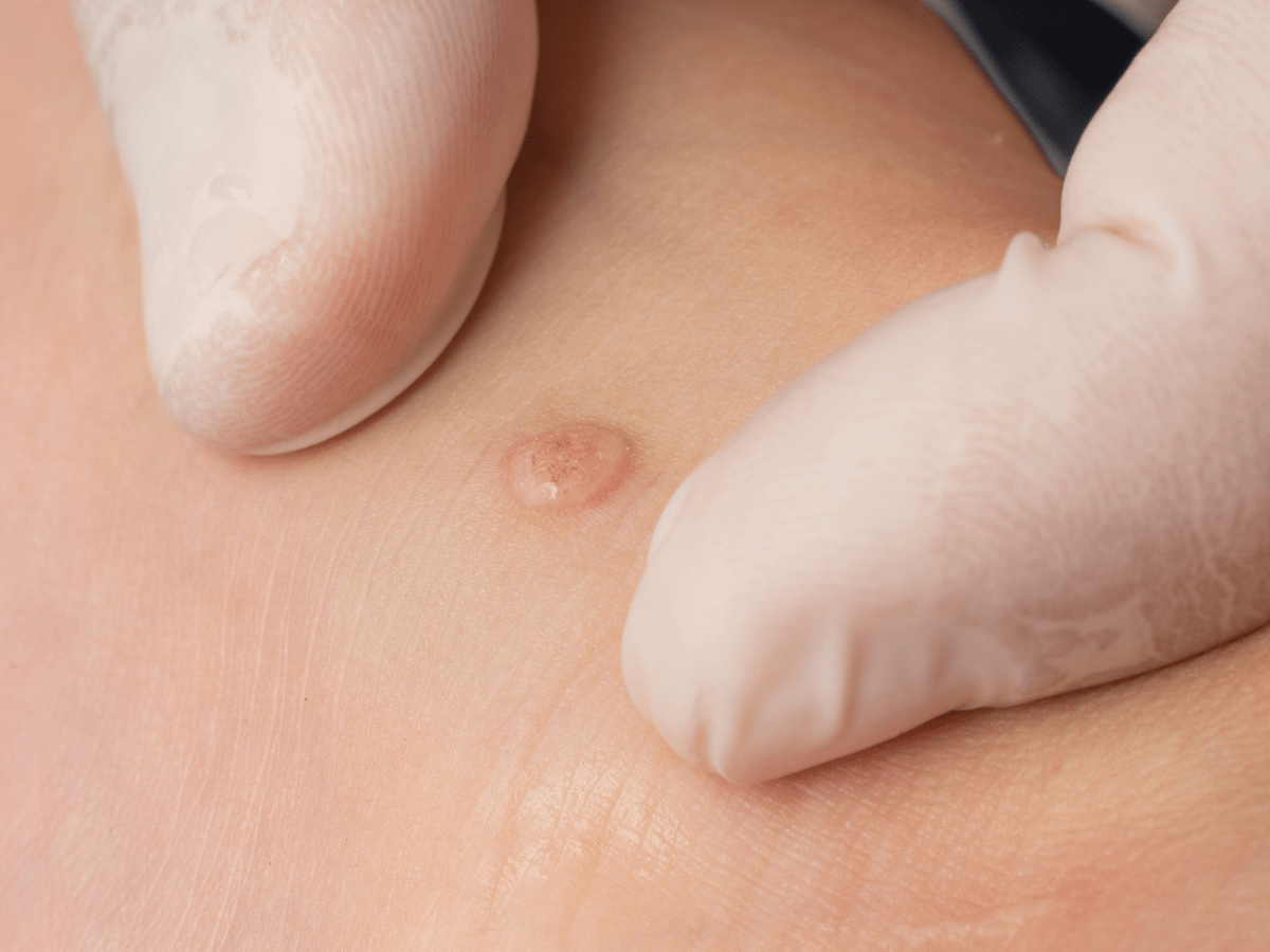 an image of a wart on someone's skin
