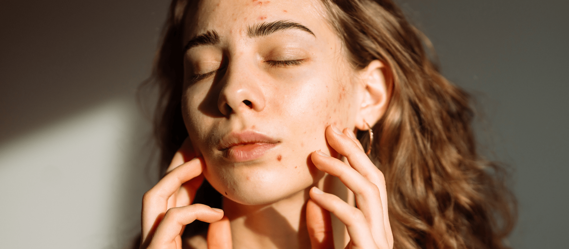 woman pointing to acne on her face