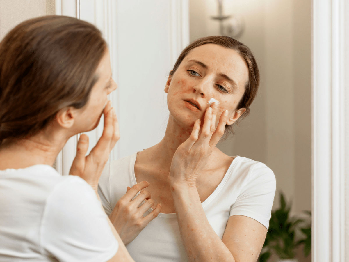woman applying cream to acne on her face