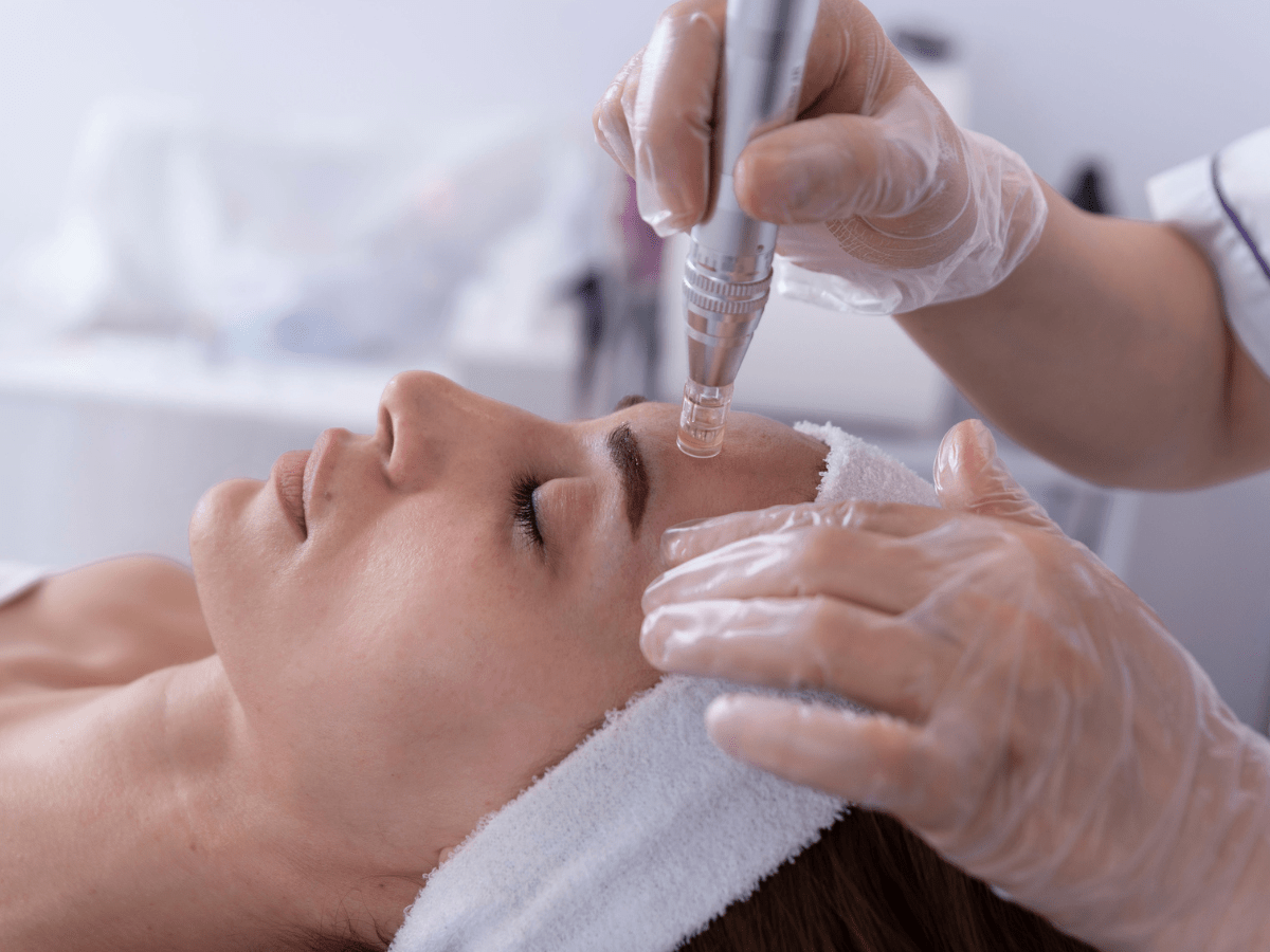 Microneedling in the forehead