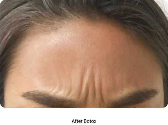 After Botox