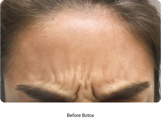 Before Botox
